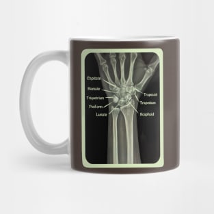 XRAY of Carpal Bones Mixed Media Mug